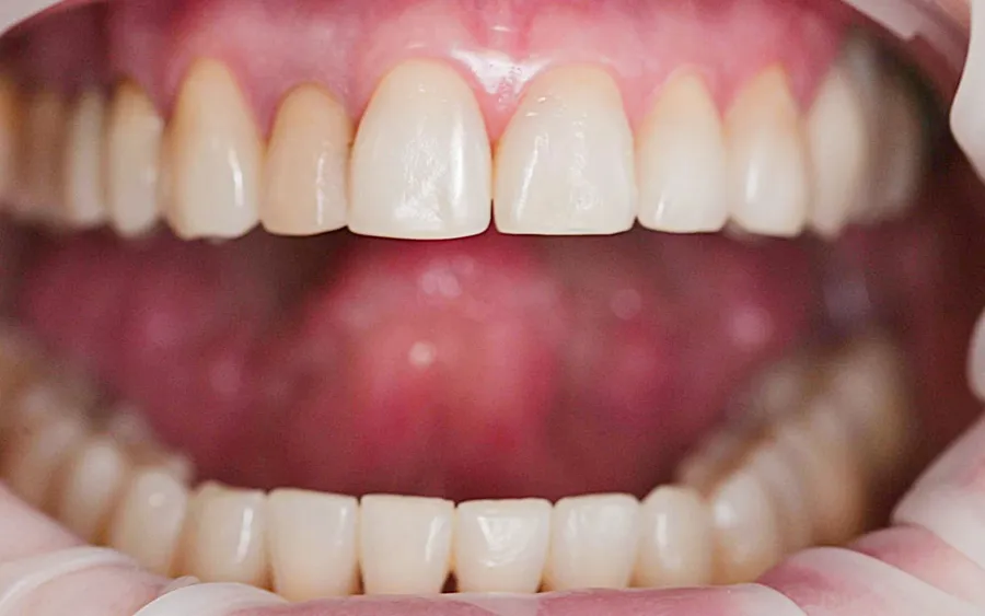 After treatment