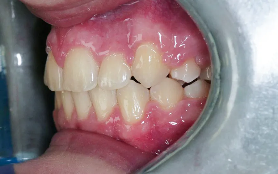 After treatment