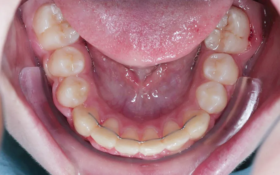 After treatment