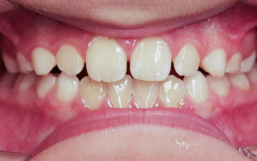 After treatment