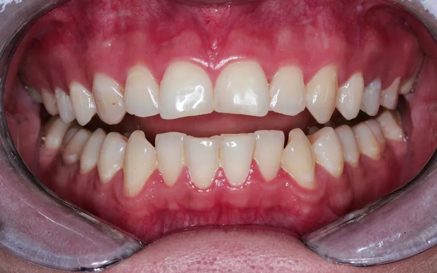 Before treatment