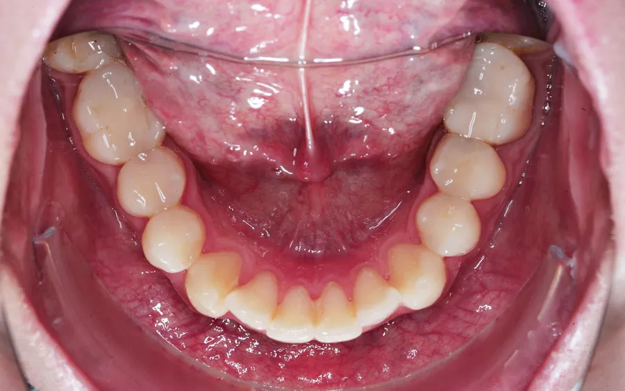 Before treatment