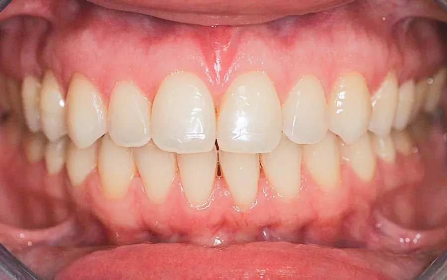 Before treatment