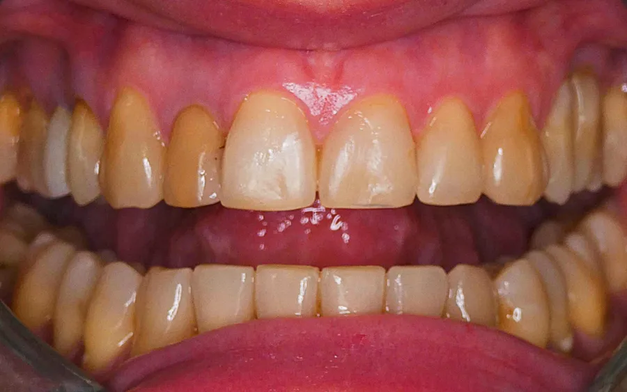 Before treatment