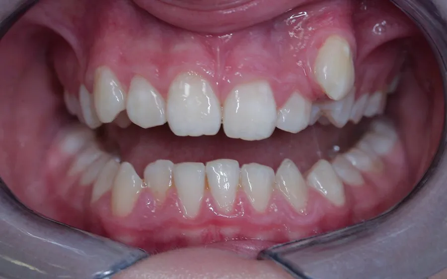 Before treatment