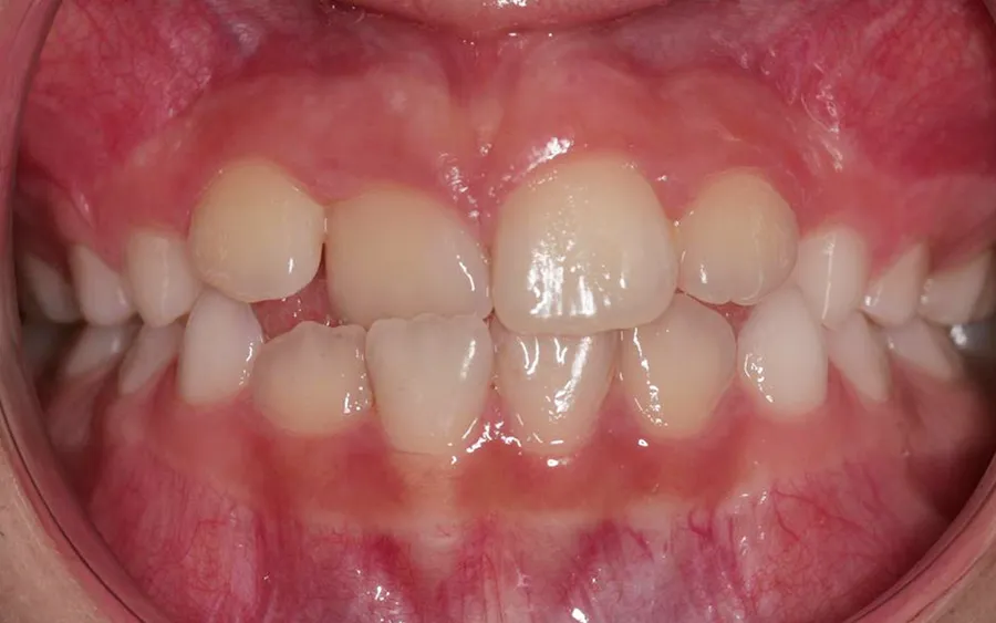 Before treatment