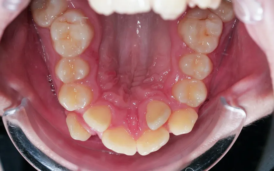 Before treatment