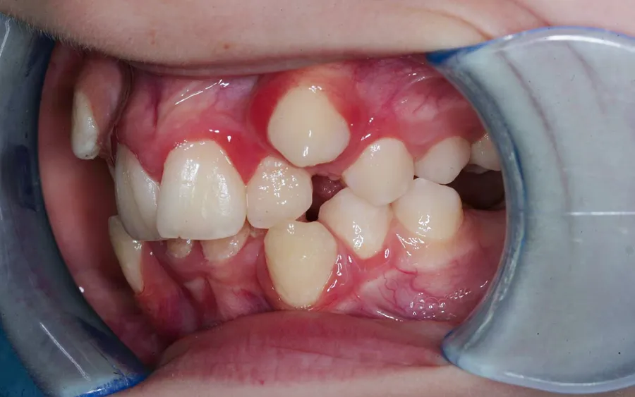 Before treatment