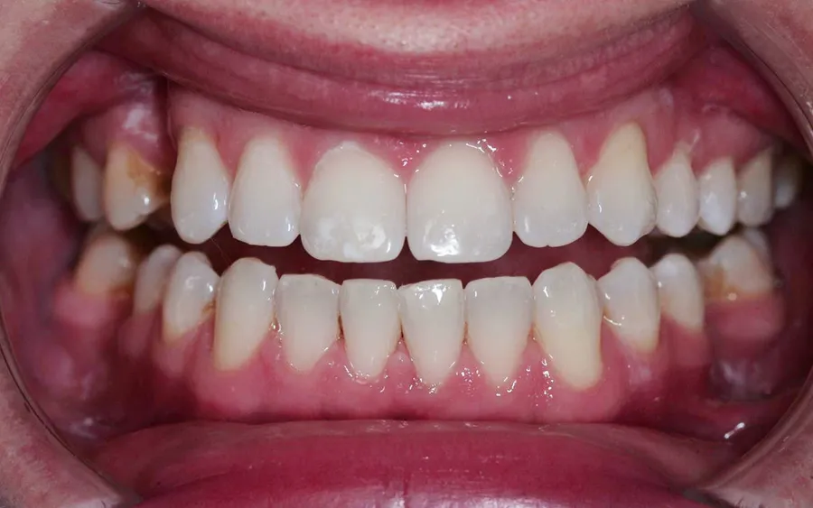 After treatment