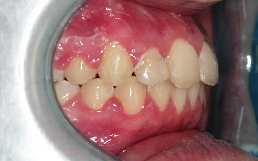 After treatment