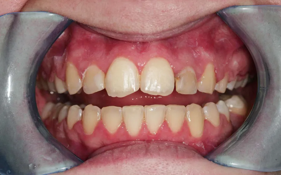 After treatment