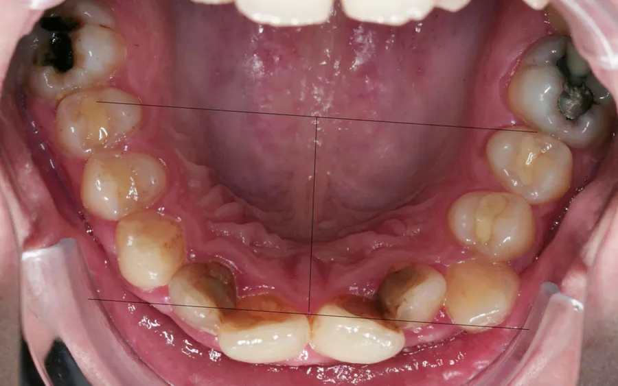 Before treatment