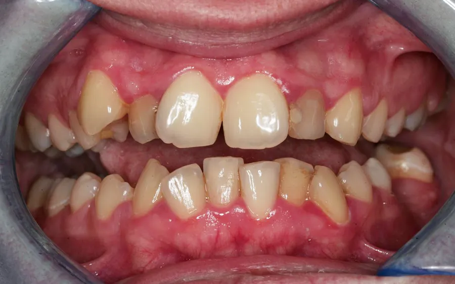 Before treatment