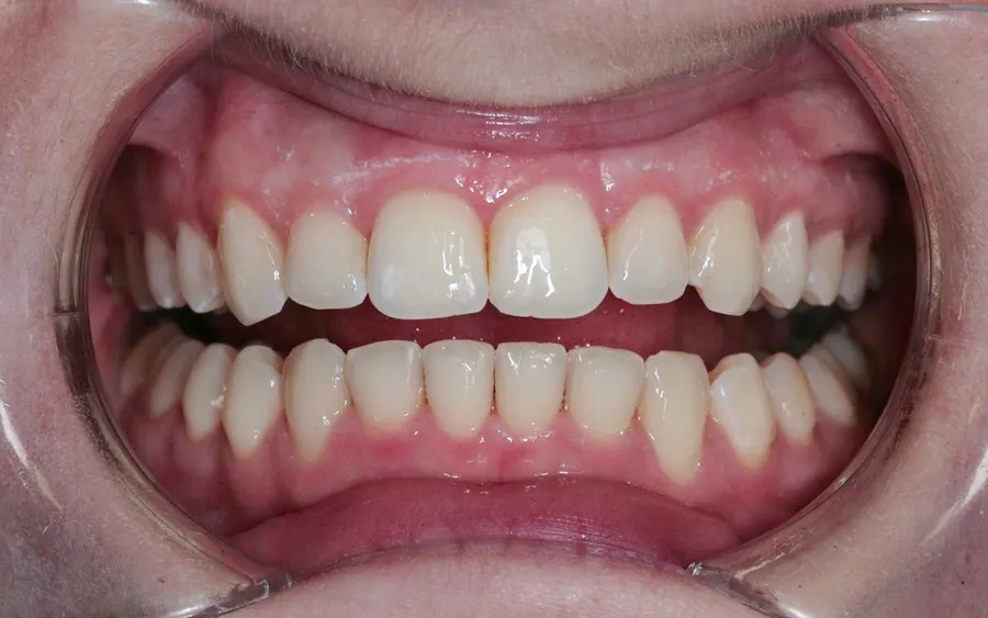 After treatment