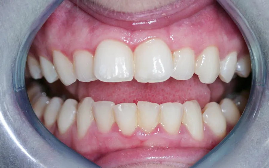 Before treatment