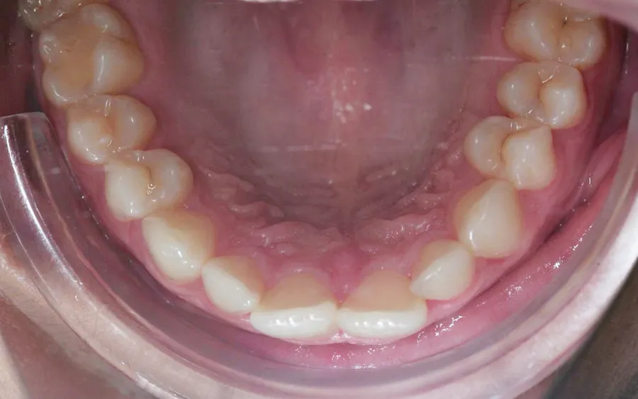 Before treatment