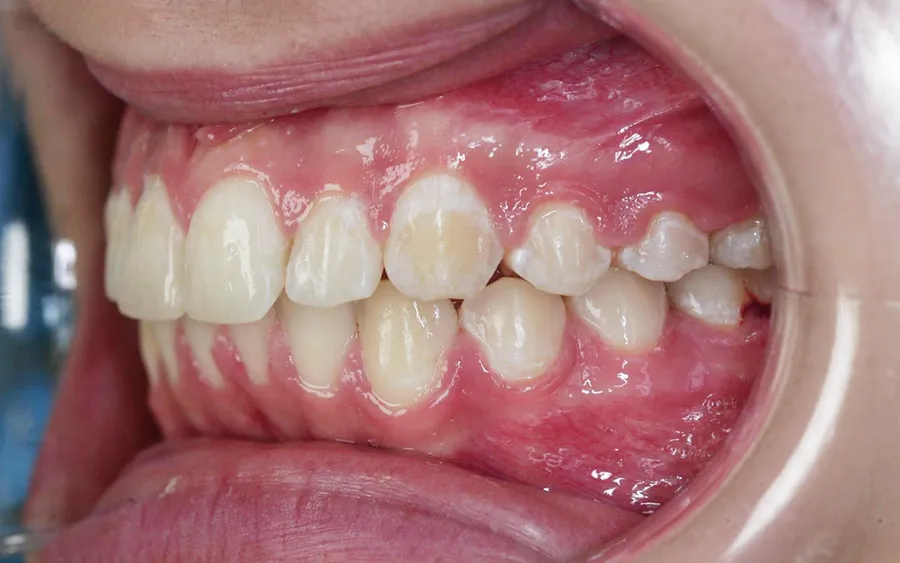After treatment