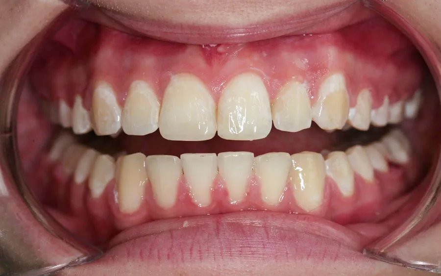 After treatment