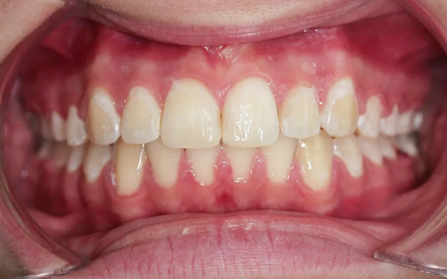 After treatment