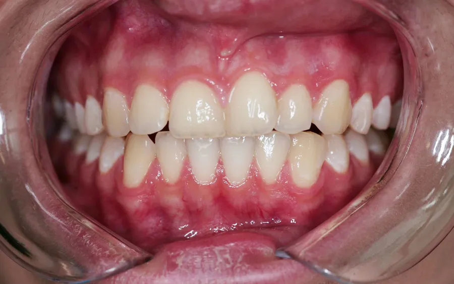 Before treatment