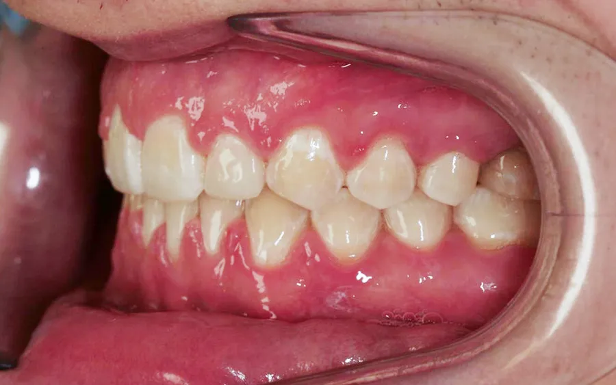 After treatment