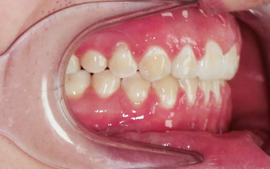After treatment